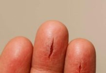 My fingertips keep splitting open in the cold, but I can’t get in to see the doctor anytime soon. What can I do now?