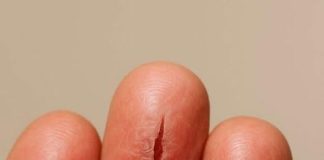 My fingertips keep splitting open in the cold, but I can’t get in to see the doctor anytime soon. What can I do now?