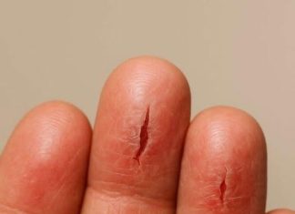 My fingertips keep splitting open in the cold, but I can’t get in to see the doctor anytime soon. What can I do now?