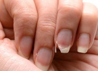 Brittle Nails? 10 Hidden Causes Your Body Is Desperately Trying to Tell You About – And How to Fix Them Fast