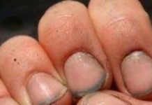 What do you call a person who has nails like that?