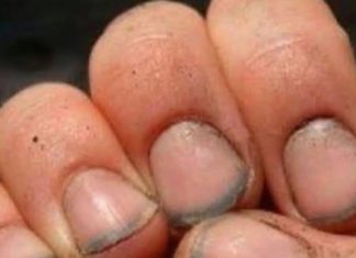 What do you call a person who has nails like that?