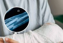 THE UNBREAKABLE MYTH BIZARRE THEORIES ABOUT PEOPLE WHO HAVE NEVER BROKEN A BONE