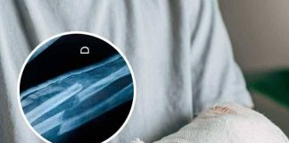 THE UNBREAKABLE MYTH BIZARRE THEORIES ABOUT PEOPLE WHO HAVE NEVER BROKEN A BONE