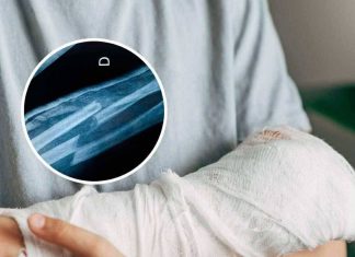 THE UNBREAKABLE MYTH BIZARRE THEORIES ABOUT PEOPLE WHO HAVE NEVER BROKEN A BONE