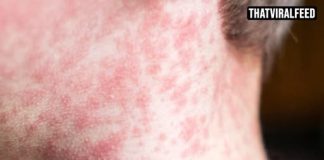 Urgent Warning Issued As US Disease Passes 2,000 Cases For The First Time In 30 Years