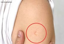 The Truth Behind the Mysterious Round Scar on the Upper Arm