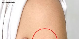 The Truth Behind the Mysterious Round Scar on the Upper Arm