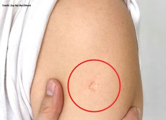 The Truth Behind the Mysterious Round Scar on the Upper Arm