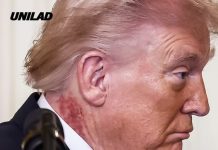 Donald Trump sparks fresh health concerns with scabbing neck rash