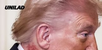 Donald Trump sparks fresh health concerns with scabbing neck rash