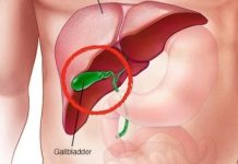 What Happens to the Body After Gallbladder Removal? 3 Diseases That May Follow – Avoid Surgery If Possible