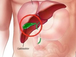 What Happens to the Body After Gallbladder Removal? 3 Diseases That May Follow – Avoid Surgery If Possible