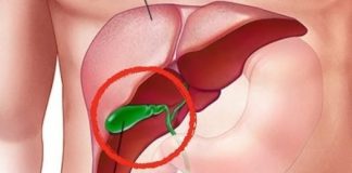 What Happens to the Body After Gallbladder Removal? 3 Diseases That May Follow – Avoid Surgery If Possible