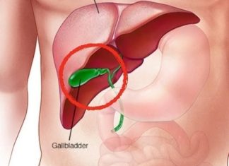 What Happens to the Body After Gallbladder Removal? 3 Diseases That May Follow – Avoid Surgery If Possible