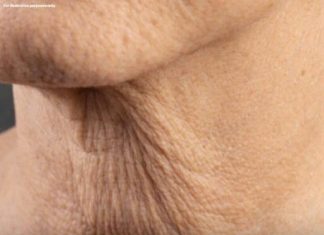 Why Neck Skin Sags as You Age — And What You Can Do About It