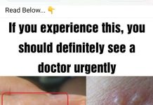 PAINFUL RED BUMPS ON YOUR HANDS OR FEET? IT COULD BE DYSHIDROTIC ECZEMA