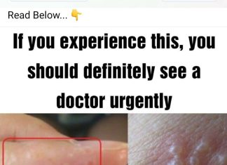 PAINFUL RED BUMPS ON YOUR HANDS OR FEET? IT COULD BE DYSHIDROTIC ECZEMA