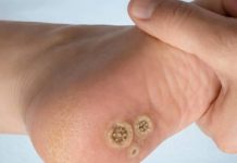 THE HIDDEN FOOT HEALTH SECRET (UNDERSTANDING THE DIFFERENCE BETWEEN CALLUSES AND PLANTAR WARTS (STOP TREATING THEM THE SAME))