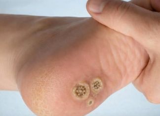 THE HIDDEN FOOT HEALTH SECRET (UNDERSTANDING THE DIFFERENCE BETWEEN CALLUSES AND PLANTAR WARTS (STOP TREATING THEM THE SAME))