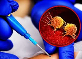 THE TRUTH ABOUT WHETHER A BIOPSY CAN SPREAD YOUR CANCER (SEPARATING MYTH FROM MEDICAL REALITY)