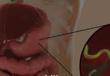 How to eliminate the bacteria responsible for heartburn and bloating