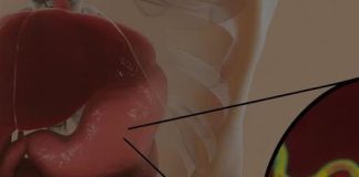 How to eliminate the bacteria responsible for heartburn and bloating