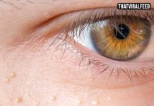 Experts Warn About White Bumps That Appear On The Body And Private Areas. Here’s What They Really Are