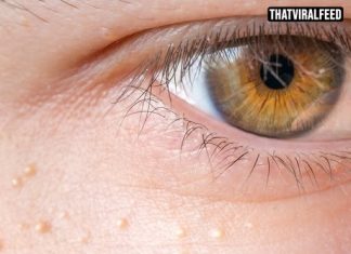 Experts Warn About White Bumps That Appear On The Body And Private Areas. Here’s What They Really Are