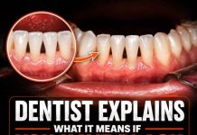 (THE BLACK TRIANGLE MYSTERY) WHY THOSE SMALL GAPS BETWEEN YOUR TEETH APPEAR AND WHAT LEADING DENTISTS WANT YOU TO KNOW ABOUT THEM