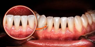 (THE BLACK TRIANGLE MYSTERY) WHY THOSE SMALL GAPS BETWEEN YOUR TEETH APPEAR AND WHAT LEADING DENTISTS WANT YOU TO KNOW ABOUT THEM