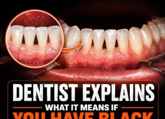 (THE BLACK TRIANGLE MYSTERY) WHY THOSE SMALL GAPS BETWEEN YOUR TEETH APPEAR AND WHAT LEADING DENTISTS WANT YOU TO KNOW ABOUT THEM