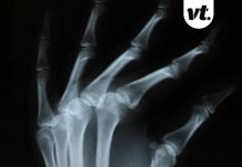 Bizarre theory explains why you’ve never broken a bone – doctor responds