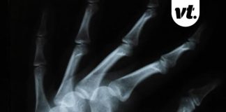 Bizarre theory explains why you’ve never broken a bone – doctor responds