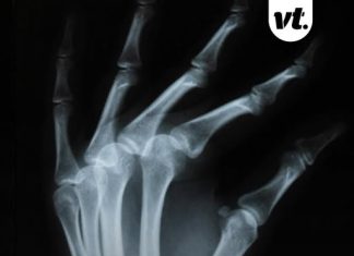 Bizarre theory explains why you’ve never broken a bone – doctor responds