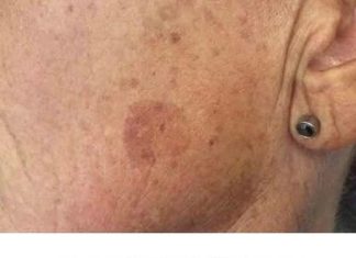 Add it to your cream and blemishes on your face will be a distant memory.
