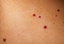 10 COMMON REASONS YOU MIGHT HAVE RED DOTS ON YOUR SKIN