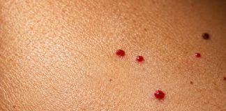 10 COMMON REASONS YOU MIGHT HAVE RED DOTS ON YOUR SKIN
