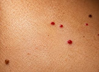 10 COMMON REASONS YOU MIGHT HAVE RED DOTS ON YOUR SKIN