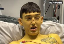 25-Year-Old Woke Up ‘Bart Simpson’ Yellow — And The Cause Went Back To Infancy