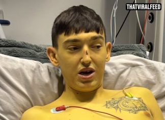 25-Year-Old Woke Up ‘Bart Simpson’ Yellow — And The Cause Went Back To Infancy