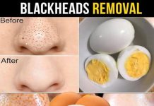 Say Goodbye to Blackheads with Just One Egg – Here’s How!