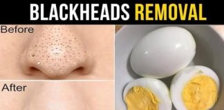 Say Goodbye to Blackheads with Just One Egg – Here’s How!