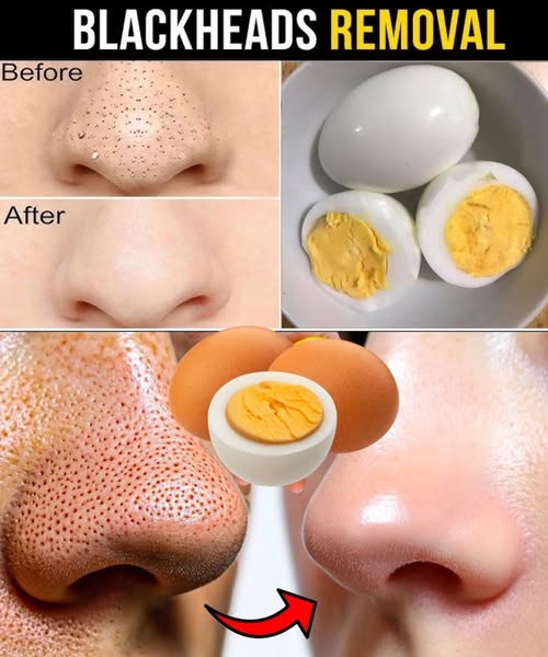 blackhead