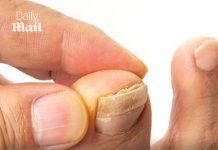 So many of us are struggling with embarrassing crusty, yellow toenails. This is the surprising habit that often triggers the problem – and exactly how to fix it: DR PHILIPPA KAYE