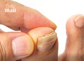 So many of us are struggling with embarrassing crusty, yellow toenails. This is the surprising habit that often triggers the problem – and exactly how to fix it: DR PHILIPPA KAYE