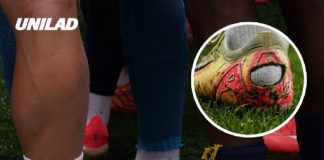 Doctor explains what causes ‘pump bump’ that has World Cup players cutting the back of soccer cleats