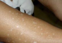 Have You Noticed Small White Spots on Your Arms or Legs? Here’s What They Are