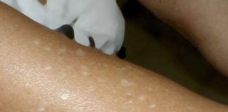 Have You Noticed Small White Spots on Your Arms or Legs? Here’s What They Are