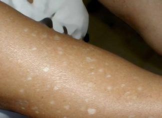 Have You Noticed Small White Spots on Your Arms or Legs? Here’s What They Are